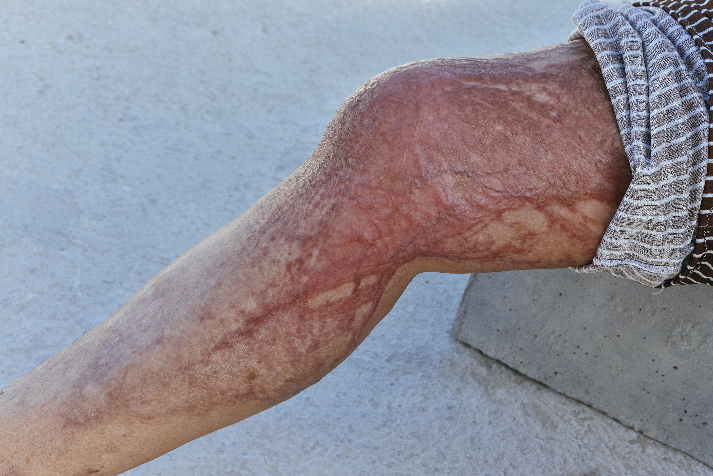 my-mothers-leg
